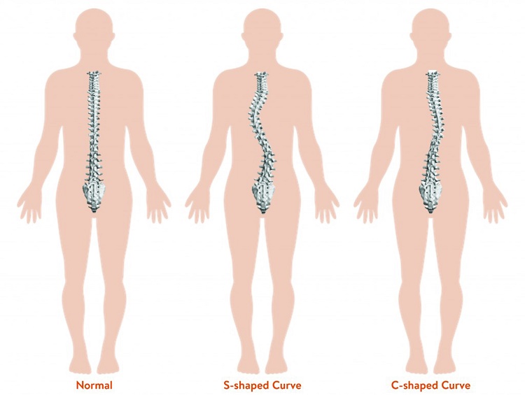 scoliosis spine shapes